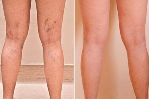 Treatment of varicose veins with laser – 100% effectiveness of the procedure