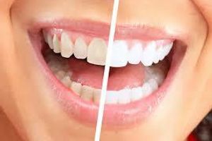 Professional teeth whitening: the path to a dazzling smile