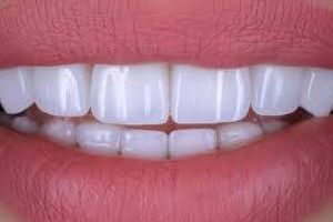 Different types of materials for veneers