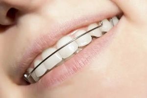 В каких случаях помогут пластины для выравнивания зубов