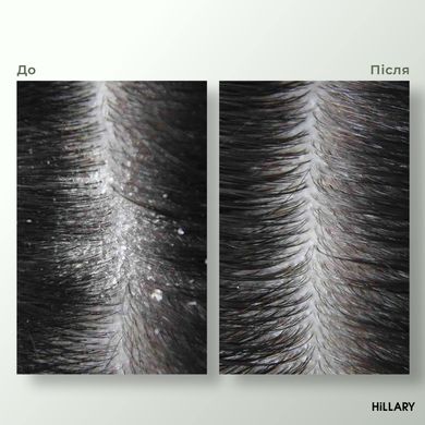 Ензимний пілінг для шкіри голови + Набір для сухого типу волосся Aloe Deep Moisturizing Hillary